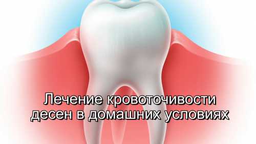 Если десны не сильно кровоточат, можно попробовать устранить недуг в домашних условиях