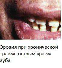 Воспаление слизистой рта: симптомы, причины, это