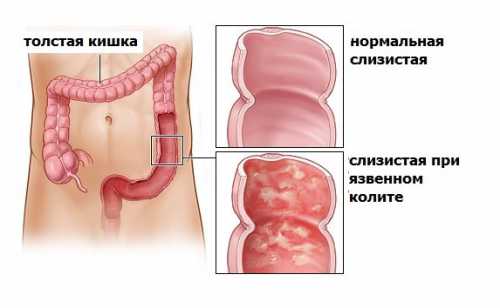 Признаки аппендицита у женщин