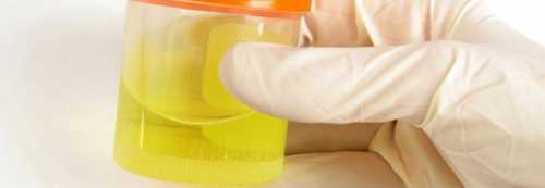 В урине появляется много одноядерных лейкоцитов, развивается активный воспалительный процесс гломерулонефрит