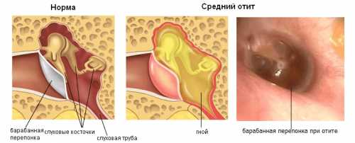 Попадание воды может вызвать временное снижение слуха и дискомфорт