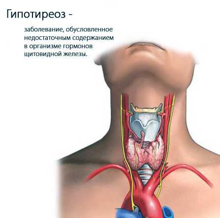 Гипотиреоз у женщин: симптомы, причины, это