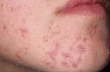 Прыщи и новообразования внутри и снаружи женского полового органа могут появляться после родов и операций