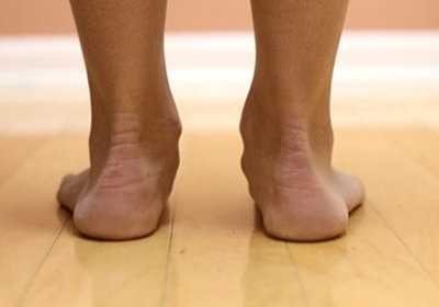 Лечение поперечного плоскостопия в домашних