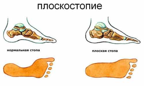 Если терапевтические мероприятия не проводятся, начинают развиваться серьезные нарушения в других местах тела