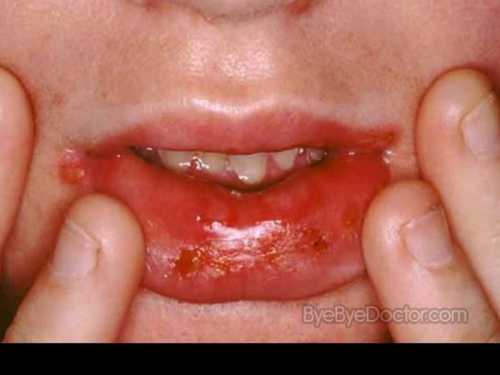 По мере прогрессирования заболевания афта меняется и покрывается мутной пленкой