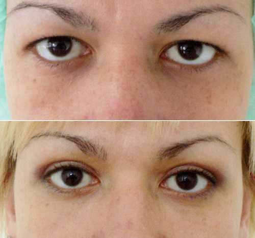 Поскольку положение наружного угла глаза в значительной степени определяет эстетику лица, канто пластика пользуется большой популярностью у молодых пациентов