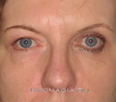 Для улучшения эстетики лица проводится моделирование глазной щели, складки верхнего века и высоты латерального угла глаза