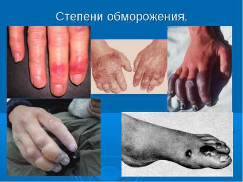 Лечение обморожение в домашних условиях: первая